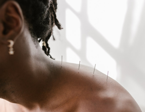 acupunture
