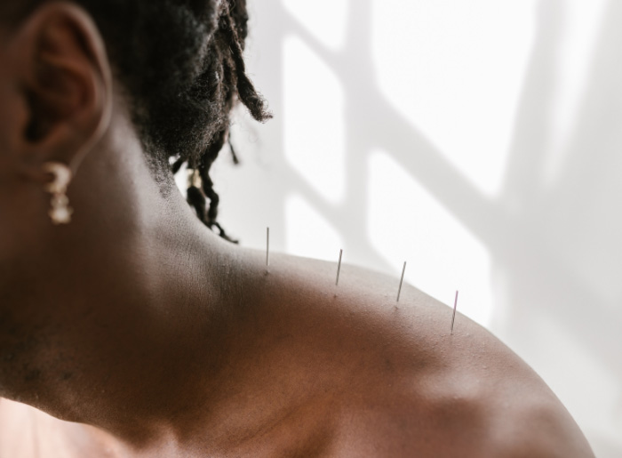 woman with acupunture needles